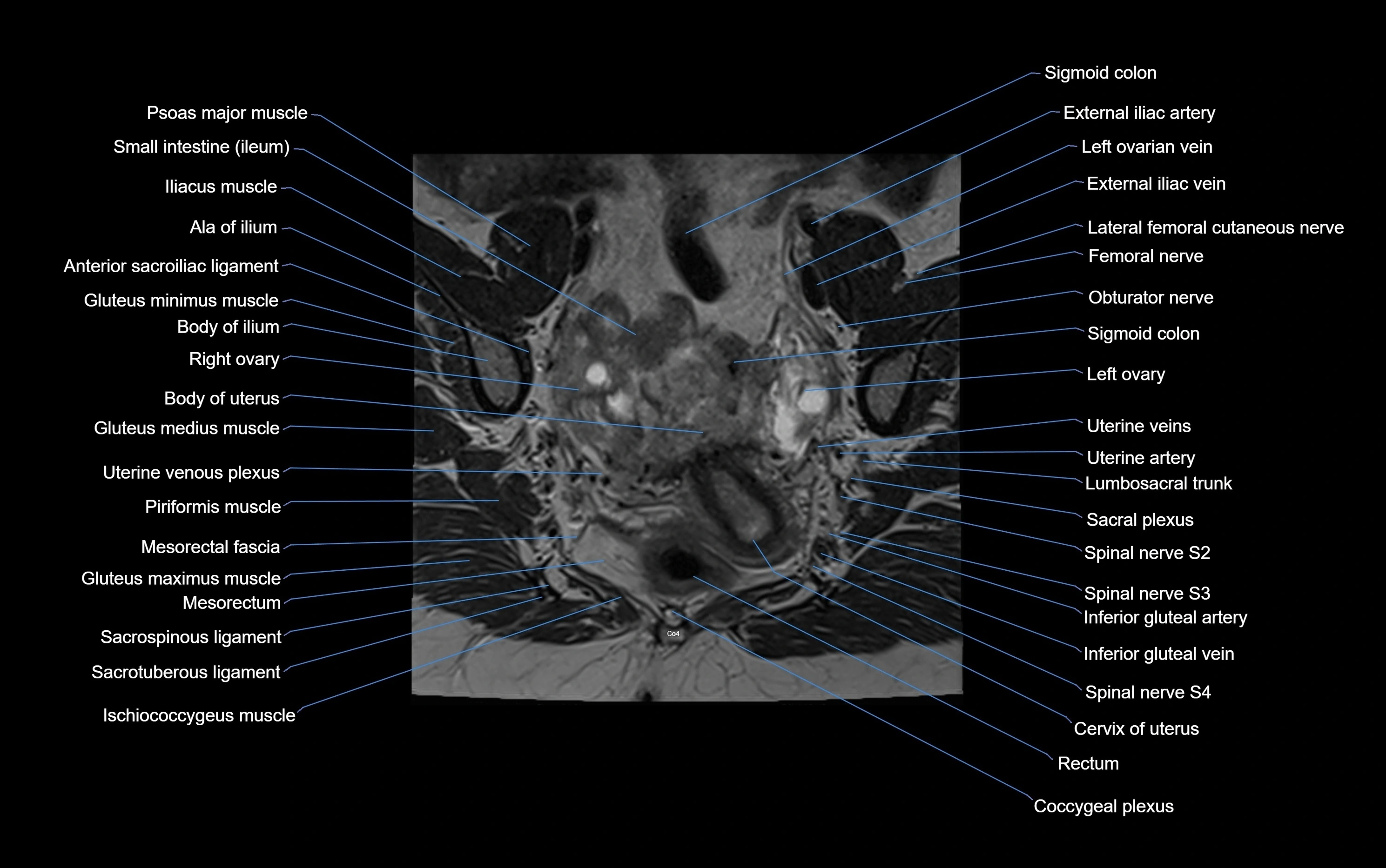 MRI sacroiliac joint coronal cross sectional anatomy  radiology  image-img-00001-00002.webp